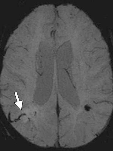 Sequence Specific Mr Imaging Findings That Are Useful In Dating Ischemic Stroke Telegraph