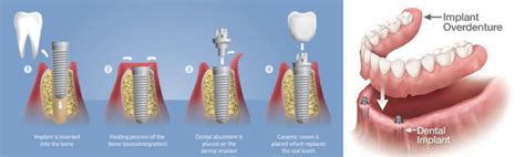 Anchorage Dental Implants Alaska Dentist