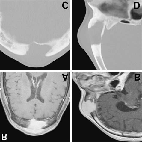 Preoperative Axial A And Sagittal B T 1 Weighted Magnetic