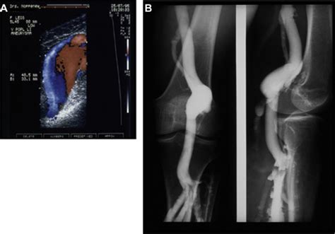 Treatment Of Popliteal Vein Aneurysms Journal Of Vascular Surgery