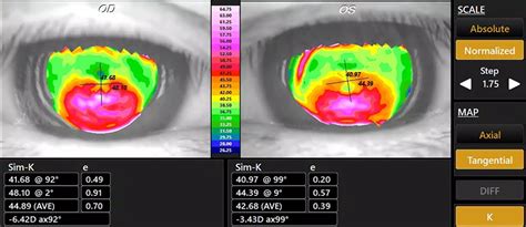 Pellucid Marginal Degeneration is Keratoconus - ReVision Optometry