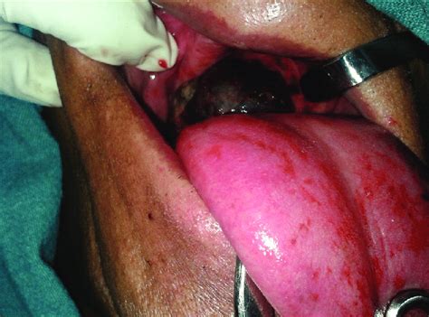 Intraoral Examination Showing A Black Colored Mass Of Malignant