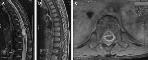 Spinal Tumors In Children Neurosurgery Clinics