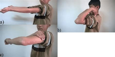 Pictures of a patient three years after surgery; a) Elbow extension. b)... | Download Scientific ...