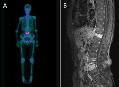 Brucellosis Spondylitis International Journal Of Infectious Diseases