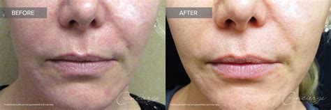 Laser Ipl Photofacial Treat Sun Damage Concierge Aesthetics Irvine