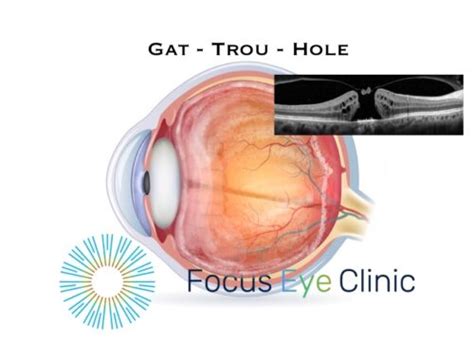 Macular hole: recovery without surgery is not possible. - Focus Eye Clinic