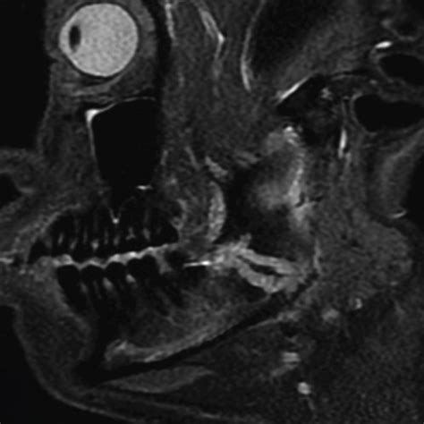 Sagittal magnetic resonance imaging (MRI) obtained during the initial ...