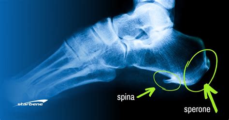 Sperone Calcaneare Cosa Fare Per Il Dolore Al Tallone