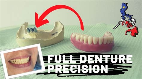 Precision Complete Denture Best Dental Optical Clinic Manila