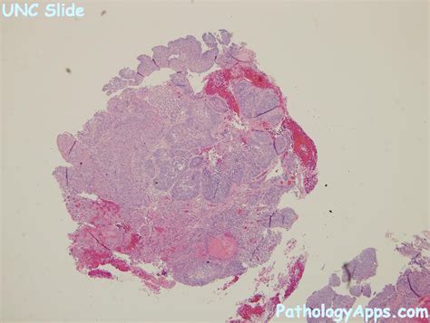 scc pathology