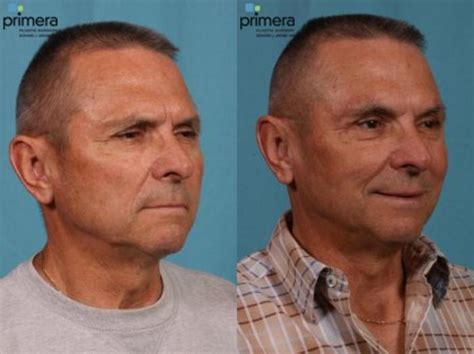 Surgery For Men Before And After Photo Gallery Orlando Florida