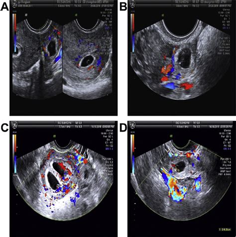 Transvaginal Color Doppler Ultrasound Images Of Patients With Hp Tvs