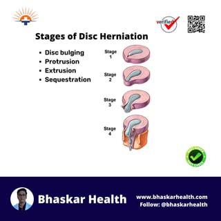 Pivd Slipped Or Herniated Disc Physiotherapy Treatment Pdf Free