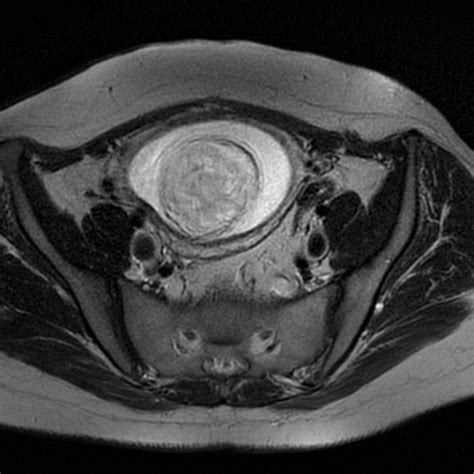 Ovarian Serous Cystadenocarcinoma Image