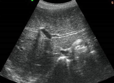 Fatty Liver Disease Ultrasound