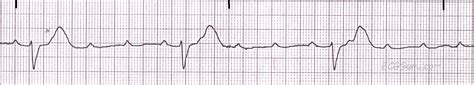 Third Degree Heart Block