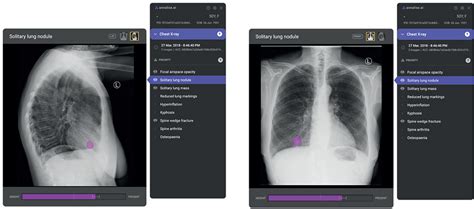 Effect Of A Comprehensive Deep Learning Model On The Accuracy Of Chest