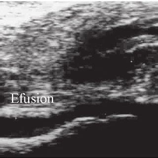 Longitudinal ultrasound examination of the hip joint, showing... | Download Scientific Diagram