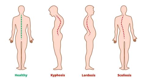 Diseases Spine Scoliosis Lordosis Kyphosis Body Posture Defects Back