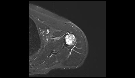 Polyostotic fibrous dysplasia MRI | Radiology Article on Polyostotic ...