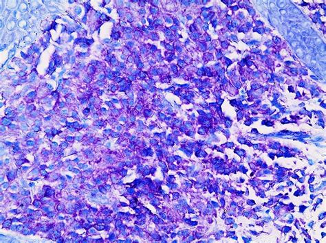 Pathology Outlines Cutaneous Mastocytosis