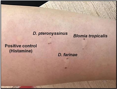 Frontiers Allergic Rhinitis A Clinical And Pathophysiological Overview