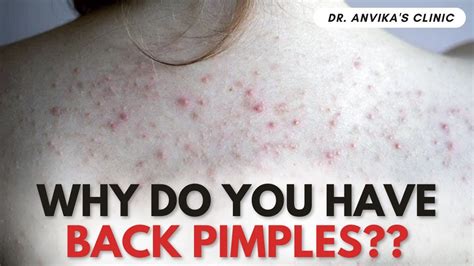 How To Remove Back Pimple Fast Causes Of Back Pimple And Treatment