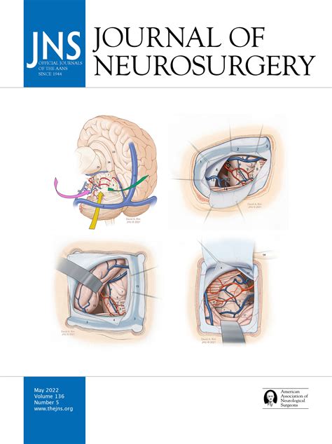 Utility Of Gpi Vim Dual Lead Deep Brain Stimulation For Parkinsons