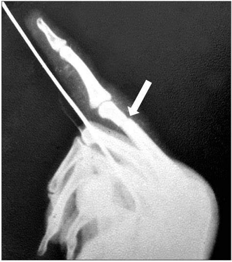 Immediate post-reduction image of the fracture shown in Fig. 3. After ...