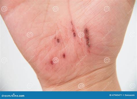 Injured Hand Stock Image Image Of Pain Asian Medicine 47945471