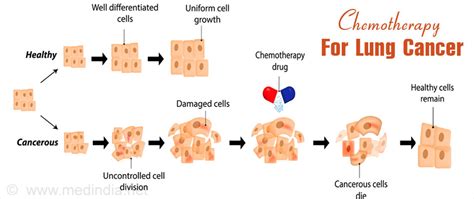 Lung Cancer Types Causes Symptoms Diagnosis Treatment And Prevention