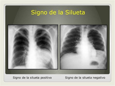 Signos Radiologicos De Torax Imagenologia Radiolog A Signos