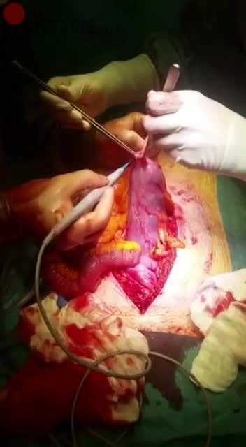 Doctor Take Dildo Out From Woman Stomach LiveGore