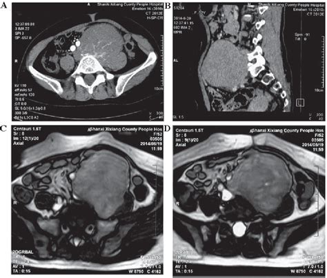 Figure From Preoperative Management Of Giant Retroperitoneal