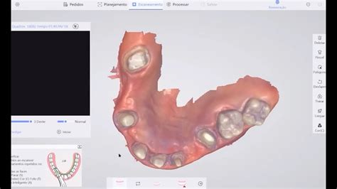 PANDA P2 Intraoral Scanner Scan Fixed Bridge YouTube