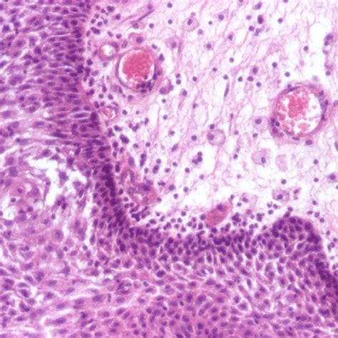 -Pilocytic astrocytoma: bipolar cells with Rosenthal fibers (HE ...