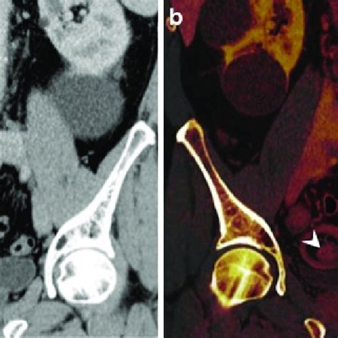 A Year Old Man With An Ileoileal Intussusception Caused By An