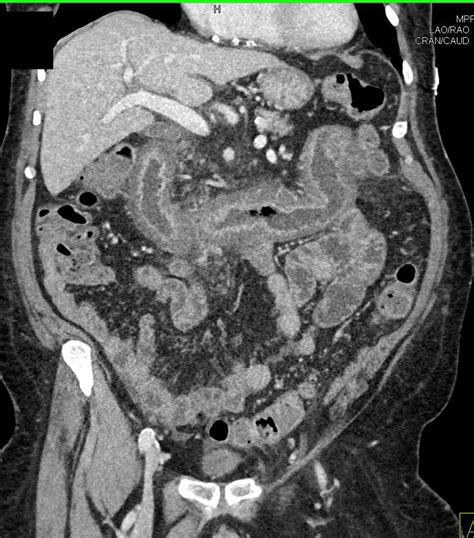 Severe Infectious Enteritis Involving The Duodenum And Proximal Jejunum