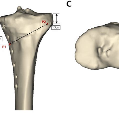 Steps To Create A Three Dimensional D Model Of A Pre Osteotomy