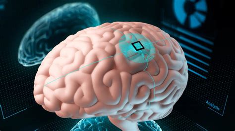 Chip De Neuralink Primer Paciente Humano Controla Una Computadora Con