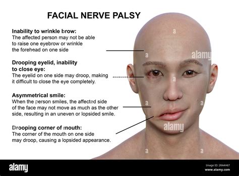 Bells Palsy What It Is Causes Symptoms Treatment 40 Off