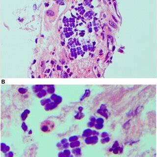 Sarcina Ventriculi In Esophageal Biopsies These Microorganisms Appear