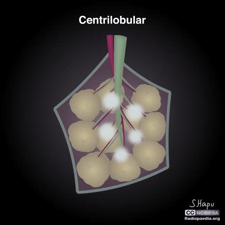 Centrilobular Lung Nodules Radiology Reference Article Radiopaedia Org