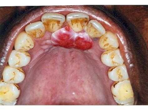 Pyogenic Granuloma In Pregnant Women