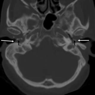 CT Of Temporal Bone Axial Image In Bone Window Showing Soft Tissue