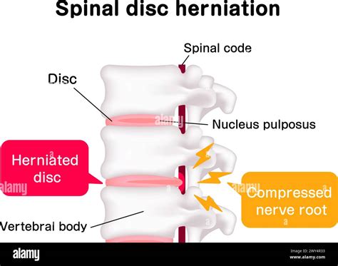 Lumbar Disc Herniation Hi Res Stock Photography And Images Alamy