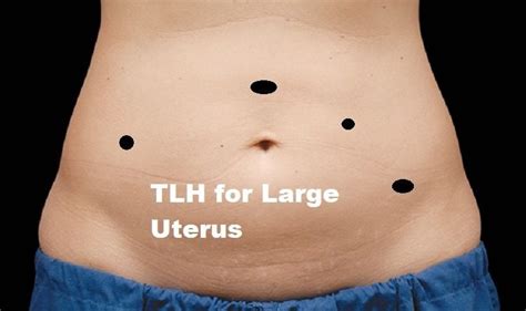 Port Position Of Various Laparoscopic Gynecological Surgeries