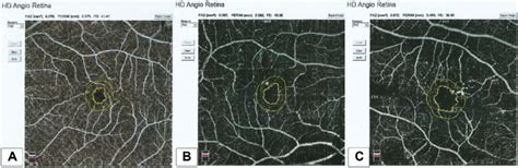 Foveal Avascular Zone Faz Area A In A Healthy Subject B In A Download Scientific Diagram