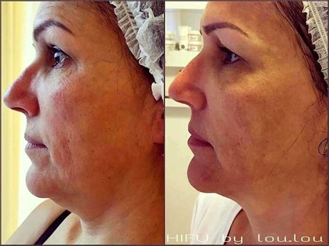 HIFU Facelift Before And After (6) » Facelift: Info, Prices, Photos ...